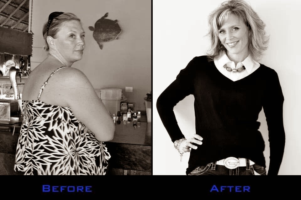 Successful Weight Loss Surgery Patients