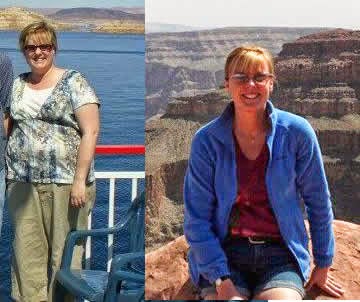 Mexicali Bariatric Patient / Five years after surgery.