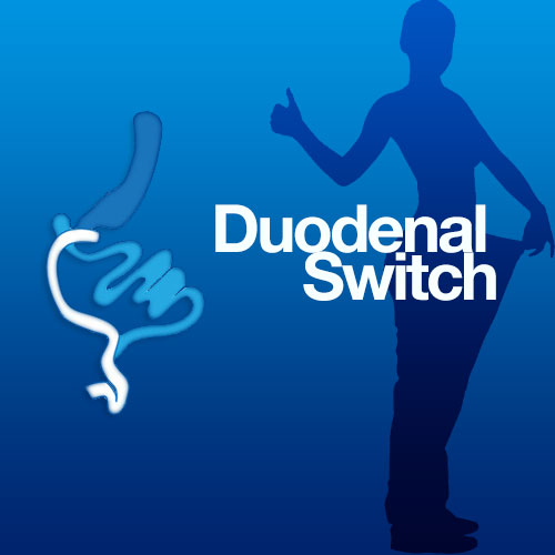 VIDEO | Gastric sleeve revision to Duodenal Switch by Dr. Ungson at MBC