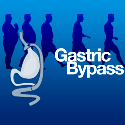 Gastric Bypass and Acid Reflux