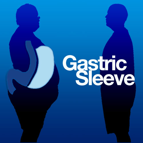 Gastric Sleeve Surgeon in Mexico